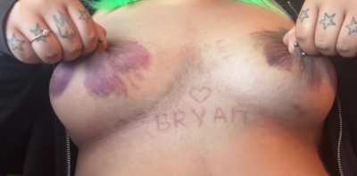 update on my bruises >.<