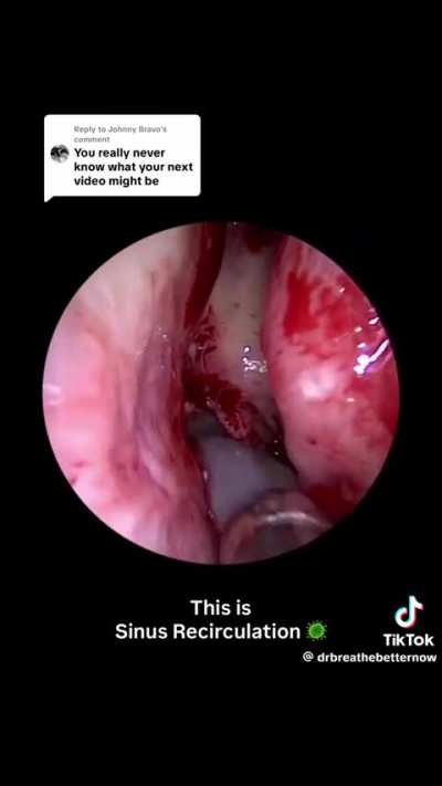 Sinus clearing