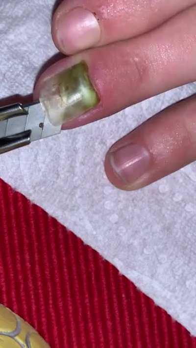 Removing broken nail