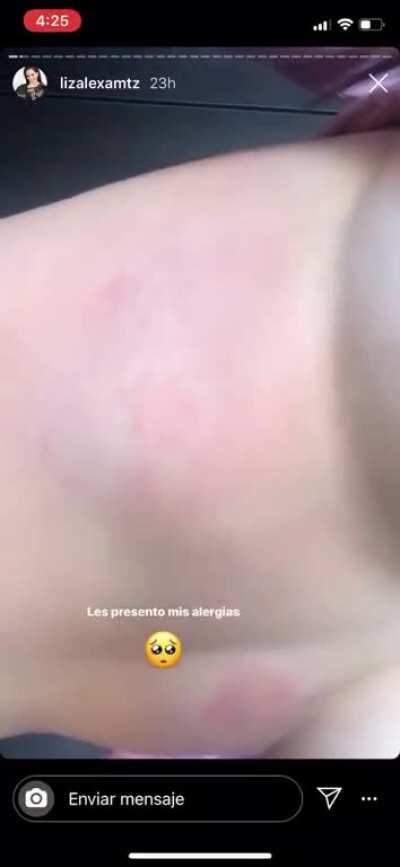 Les presento sus alergias