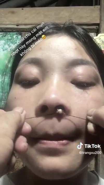 This looks sore as heck, but the way it pops out is kind of satisfying?