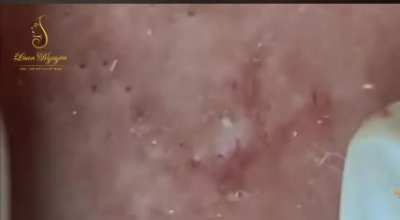 Black and whiteheads