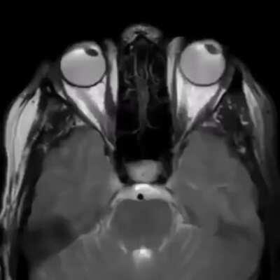 The way the optical nerves move with eye movement.