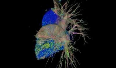 ct pulmonary angiography