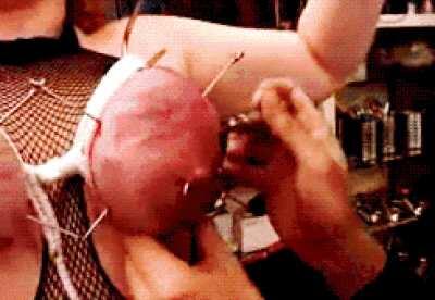 Accupuncture has come a long way.