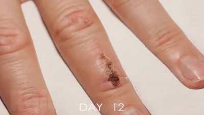 Wound healing time lapse