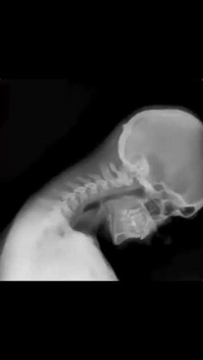 Dynamic Digital Radiography (DDR)