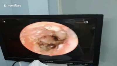 Mushrooms growing in man's ear.