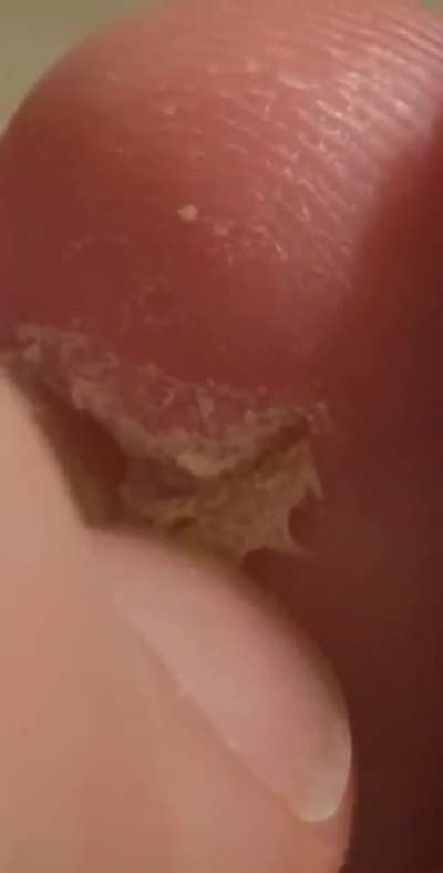 Toenail from OSRS addiction lifestyle