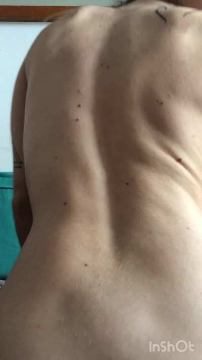 Hope you like the moles of my back