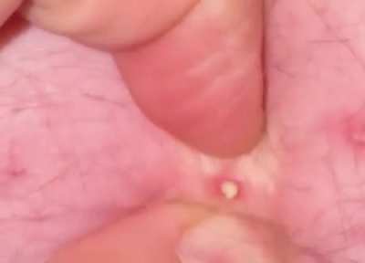 Quick pop on my husbands back, small amount of blood