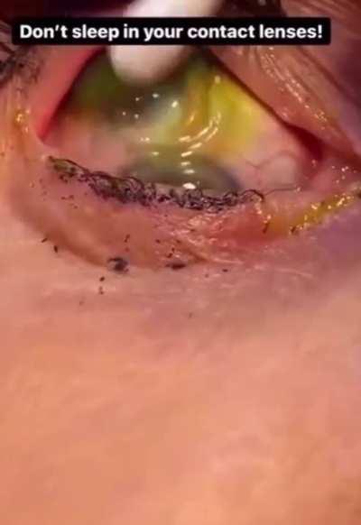 She slept with contact lenses and woke up without. Now she has found the missing 23.