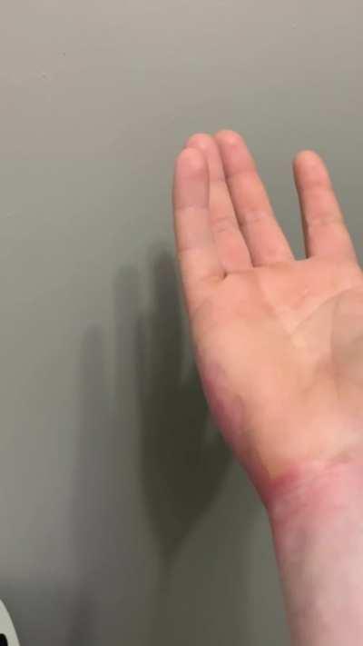 UPDATE: my friends had about a week and a half later no need for skin grafts or anything like that!! I appreciate everyone’s concern!