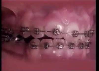 How braces work