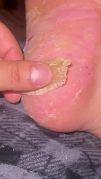 Foot peeling