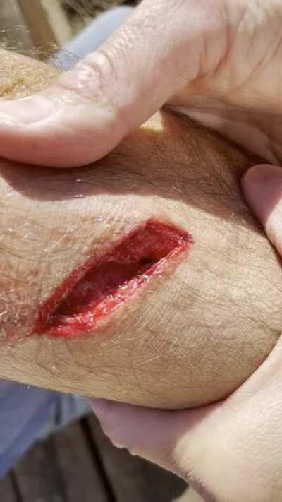 67 year old dad falls off the second story roof and got a nice gash in his arm.