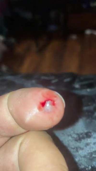 Tried to stop two Yorkies from fighting....got a bite all the way through my nail.