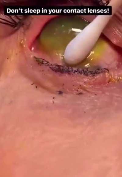 She slept with her contact lenses in and lost them. Then she rinsed and repeated. And repeated. And repeated. And repeated. And repeated.