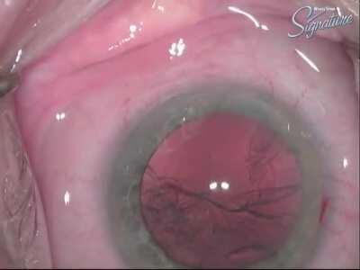 My dad performing a lens replacement surgery