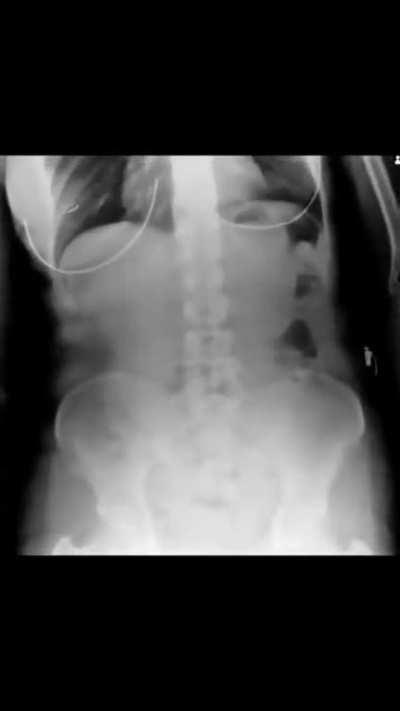 Dynamic Digital Radiography (DDR)