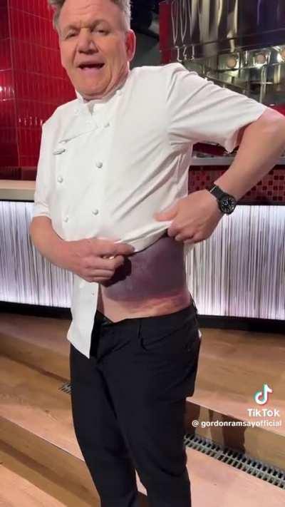 Gordon Ramsay shows bruise from cycling accident