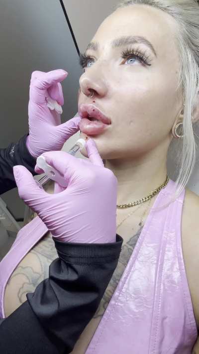 Real life bimbofication lip expansion