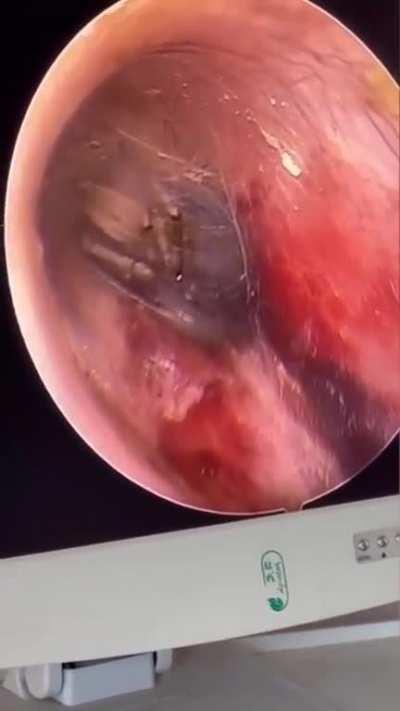 Spider crawls in a guy’s ear while he slept