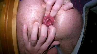 Here's how Prolapsevillians use a cockring...