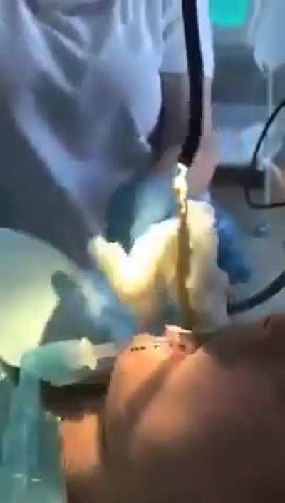 Tapeworm as huge as a snake removed from a woman's mouth