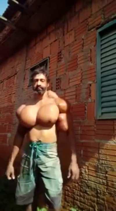 This man who has injected synthol into his arms and chest