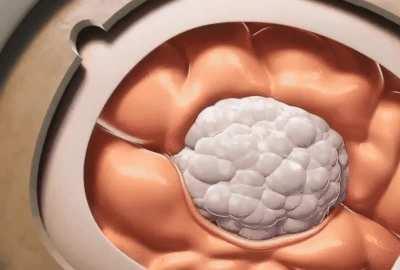 How to brain surgery (tumor removal).