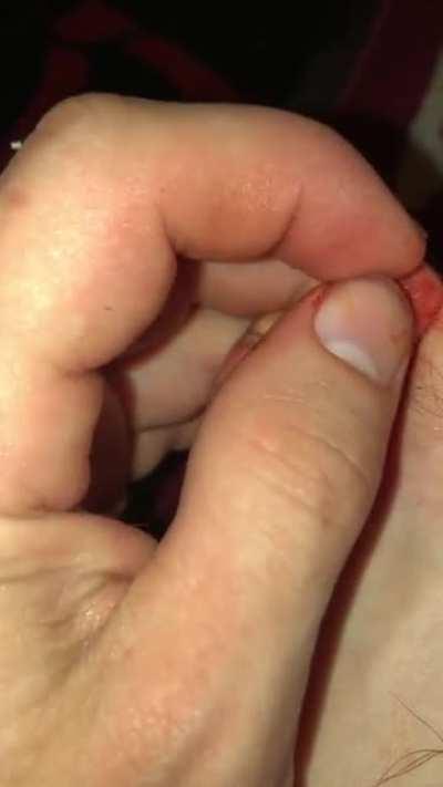Removing broken toe nail