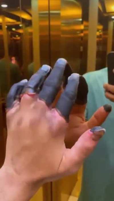 Mild case of frostbite