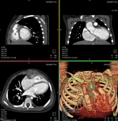 CT Scan of a heart beating. (computed tomography). Views: side, anterior, cross-sectional, and reconstruction. Cross sectional view shows the smaller atria on the left and the larger ventricles on the right.