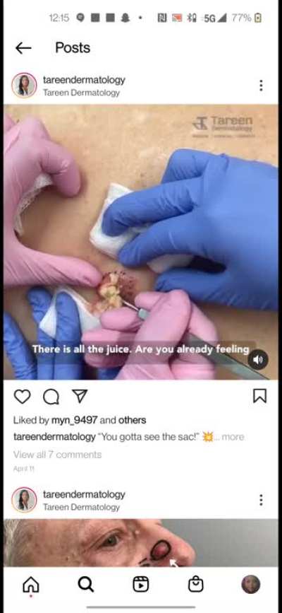 Dr. Cyst Scooper, scoops an angry cyst! lol