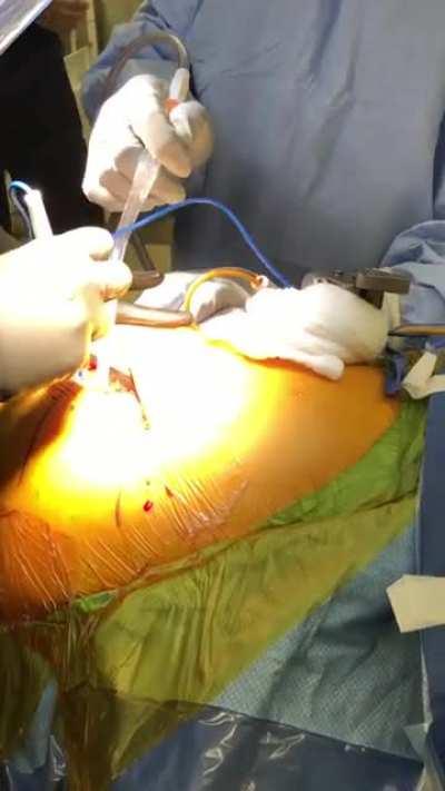 Septic hip, 10yrs post-op total arthroplasty