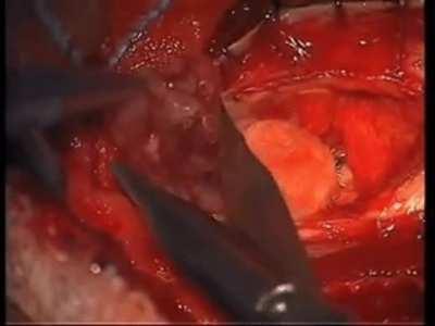 This was growing on someones spine