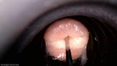 cervix wrinkles as large sounding rod pushes inside