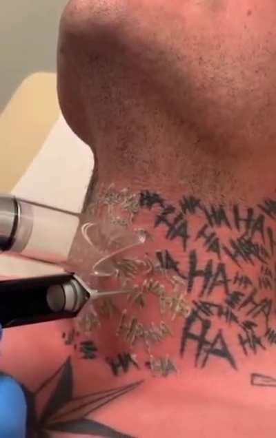 Tattoo removing