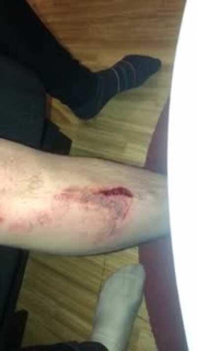 Fell in some weird hole while out walking, fucked up my foot pretty well too. Here’s me putting hand sanitizer on my fresh wound. Do not recommend