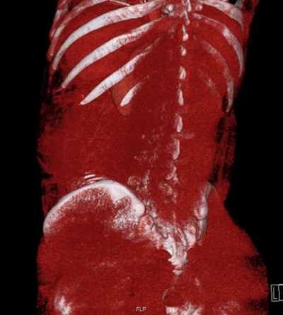 Volume rendered CT scan of a 37 weeks pregnant woman