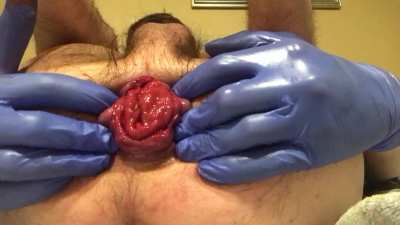 My first Prolapse