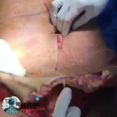 Abdominoplasty ( tummy tuck )! After watching this video, I don't think I will eat more than a salad a day for the few next days :O