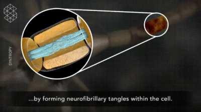 What happens to the brain during a concussion