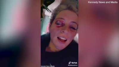NSFW Girl explains how her lash technician's dog attacked her and damaged her eyelid.