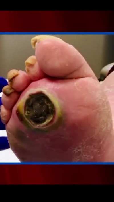 Dr. Jeffrey Treats Large Plantar Ulcer