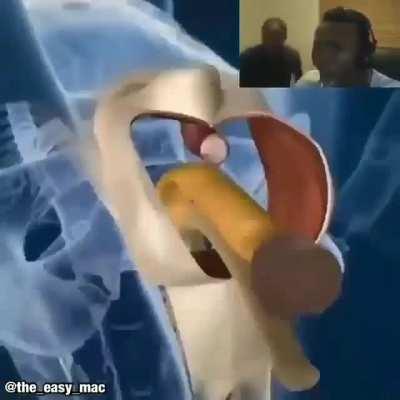 İlki manksien in yapmaya düşündüğü ameliyat.İkincisi yok reddit sadece tek yüklettiriyor