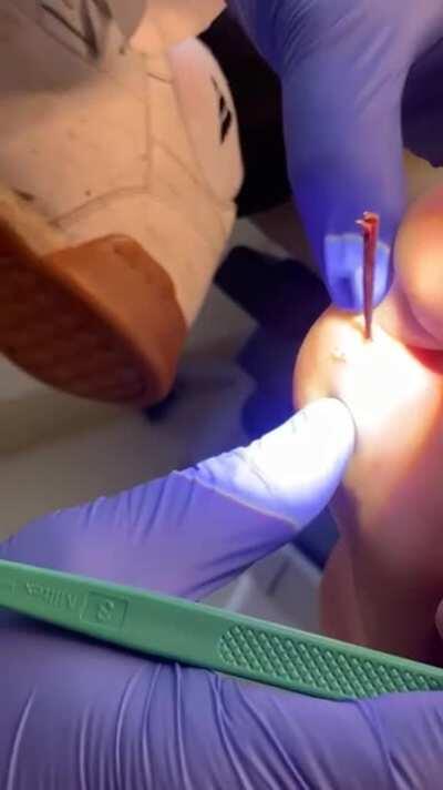 Splinter Removal