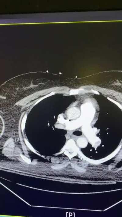 D Dimer 3200; hypoxia pretty bad PE.