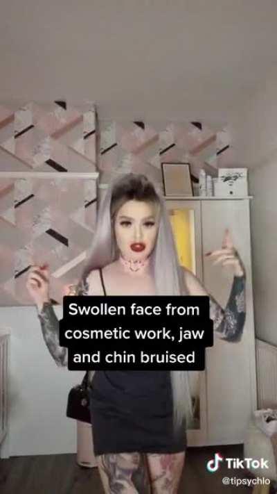 My guess is she’s going to get that filler mustache dissolved. Hopefully I’m right 🤞